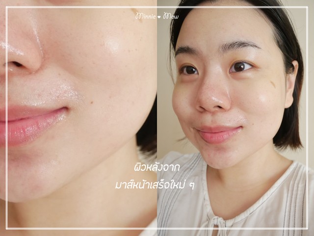 1606228723 acne solution 06