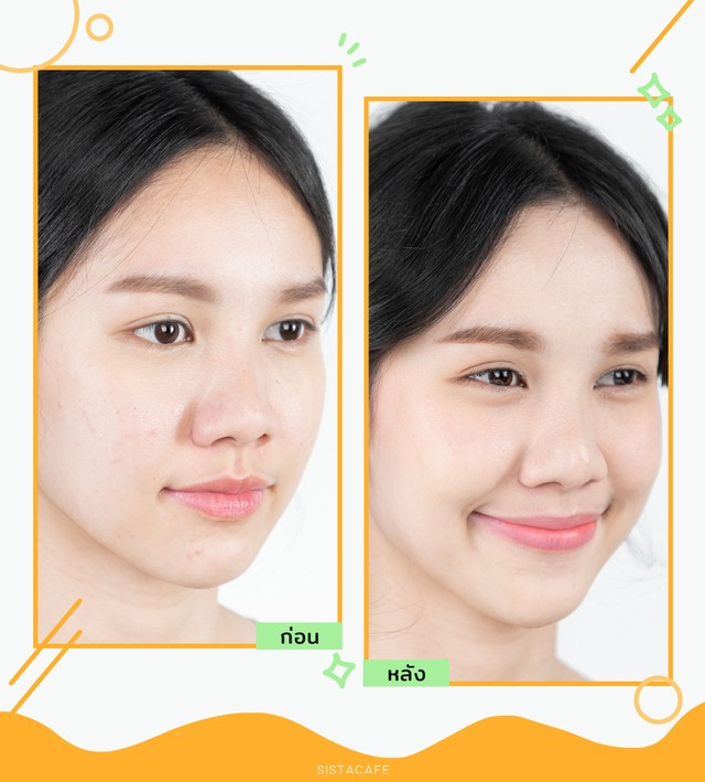 รีวิว Clean & Clear acne clearing cleanser ล้างหน้า ช่วยลดสิวได้