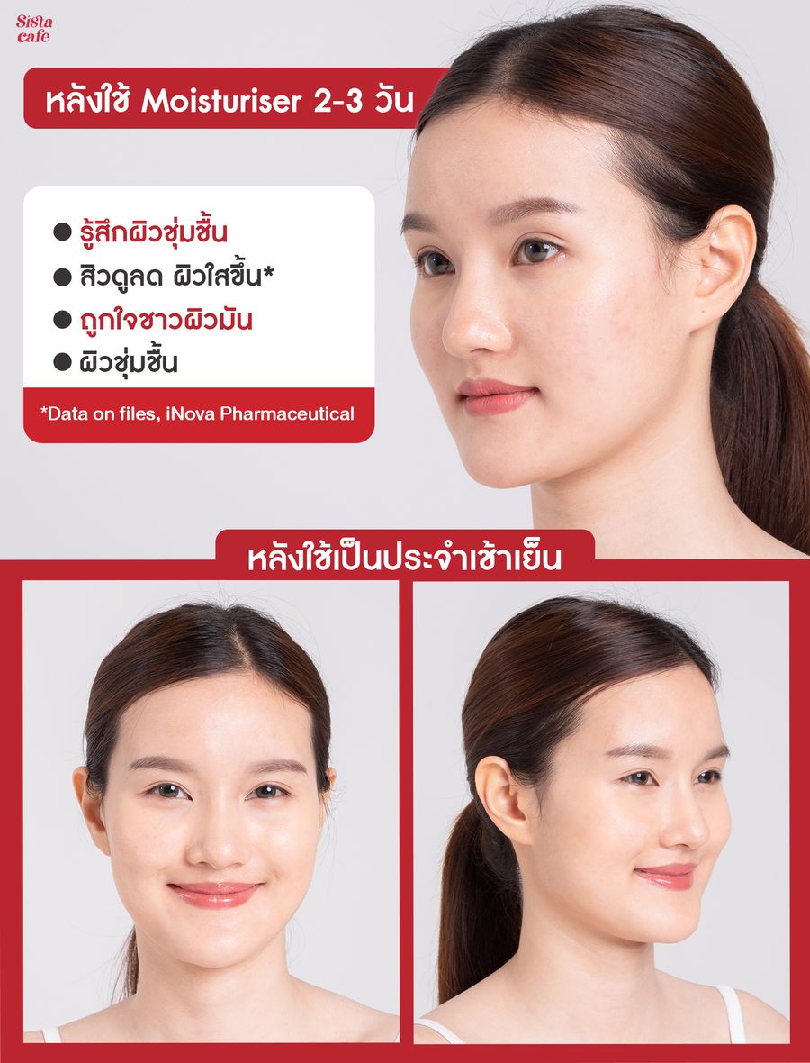 ความรู้สึกหลังใช้ acne-aid moisturiser