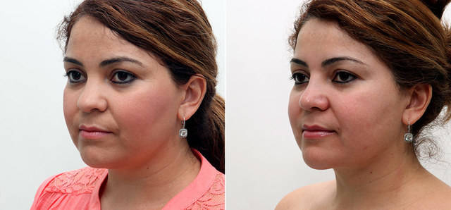 1463037343 neck contouring 102b