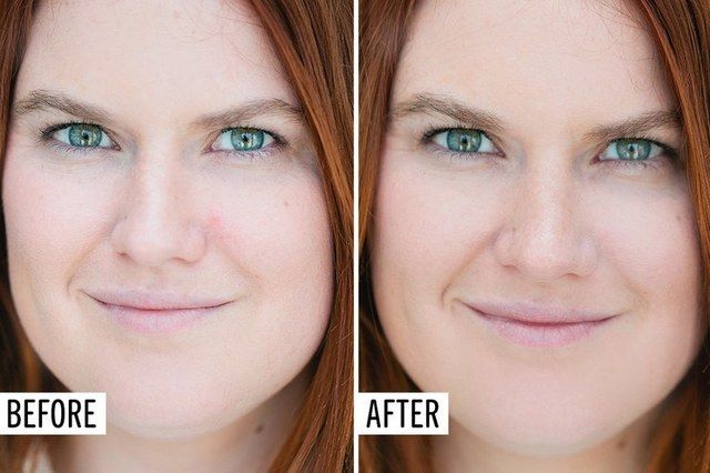 ภาพ Before-After การปิดรอยสิวขั้นเทพ 