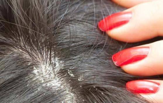 1473502387 how to get rid of dandruff at home home remedies for dandruff