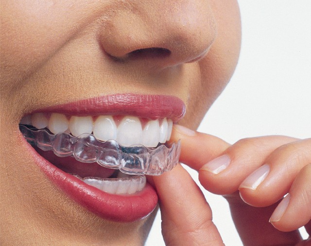 จัดฟันแบบใส Invisalign ห้ามกิน