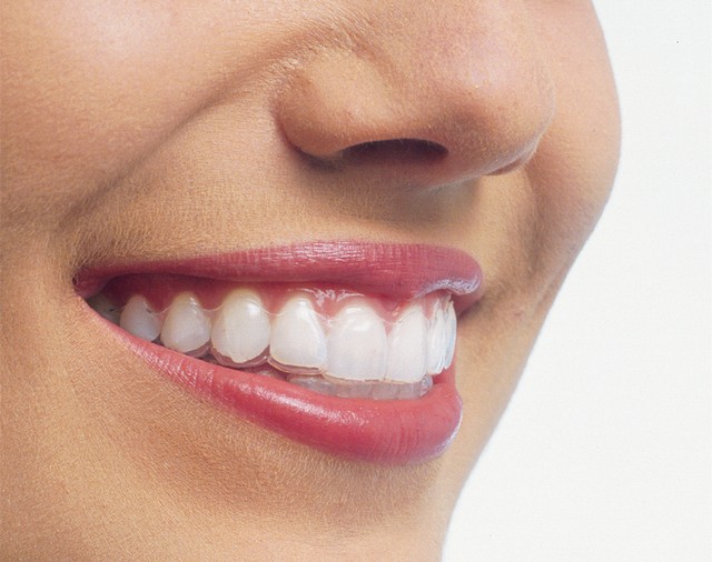 จัดฟันแบบใส Invisalign ไร้เหล็กดัด