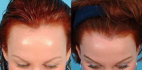 1502643205 before and after anion for hair growth receiding hair line