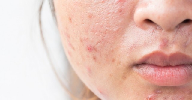 1522912809 how to get rid of acne fast 800x416