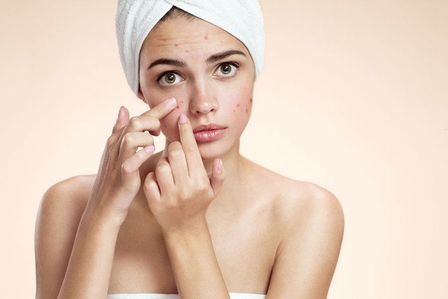 1529377764 how to treat acne