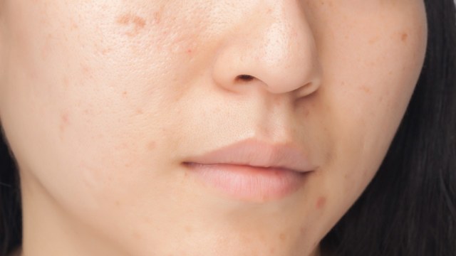 1553066816 melasma 2520vs 2520hyperpigmentation