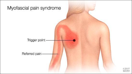 1555478753 a medical illustration of myofascial pain syndrome 16x9