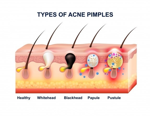 1569507110 skin acne anatomy composition 1284 18003