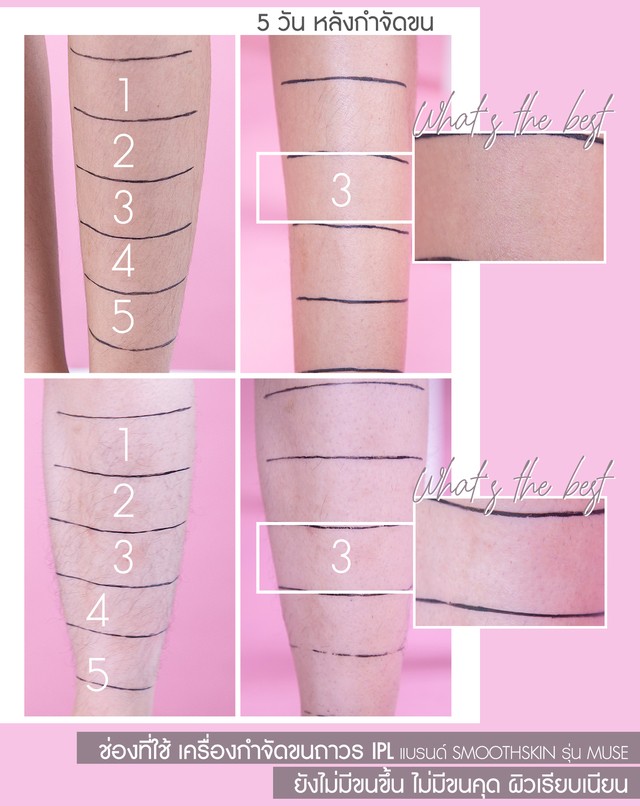 กำจัดขน_วิธีกำจัดขนที่ดีที่สุด_เครื่องเลเซอร์กำจัดขนถาวร Smoothskin Muse IPL Hair Removal
