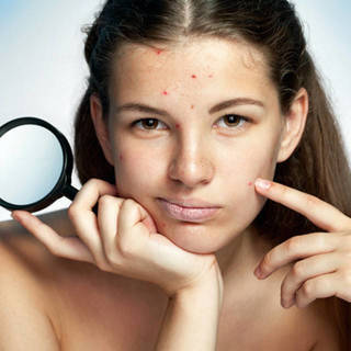 1460113146 1459518696 food for acne prone skin