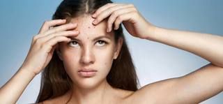 1477560263 pimples on for head
