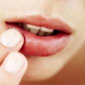 Icon 1444528828 1444527474 mouth ulcers