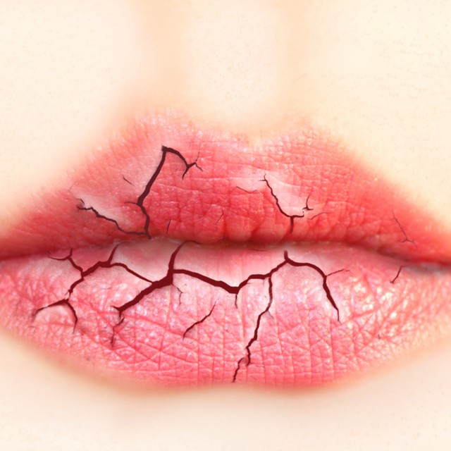 Cracked and dry lips