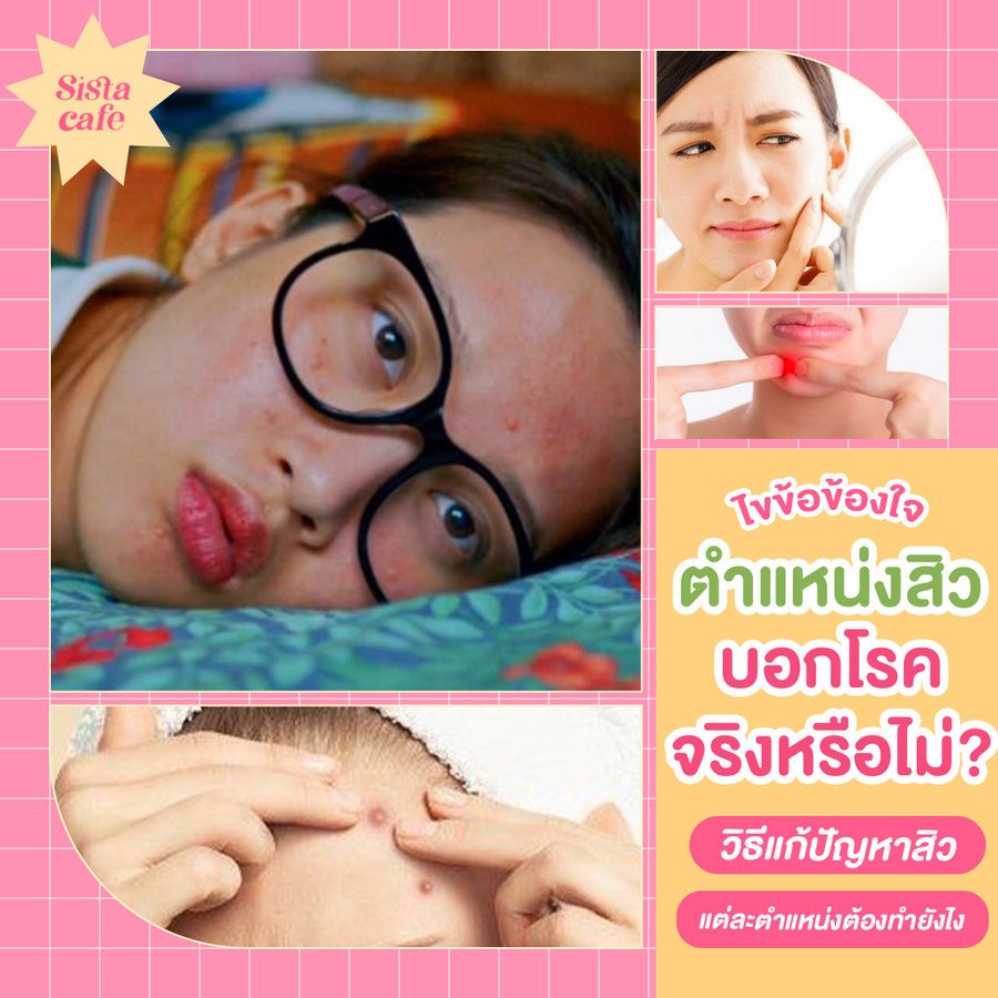 ตำแหน่งสิวบอกโรคและวิธีแก้