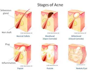 https://image.sistacafe.com/w200/images/uploads/content_image/image/179438/1470821820-stages-of-acne.jpg