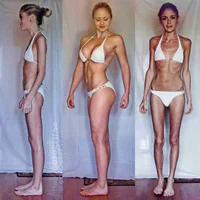 https://image.sistacafe.com/w200/images/uploads/content_image/image/82679/1453173499-linn-stromberg-anorexia-transformation.jpg